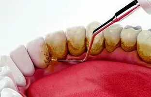 راهکار‌های پیشگیری از تشکیل جرم دندان + ویدئو