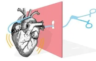 سیر تکامل جراحی قلب؛ از بخیه تا پیوند/ نخستین دریافت‌کننده پیوند قلب چند روز زنده ماند؟