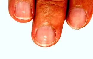 تغییرات ناخن چه هشدارهایی دارد؟