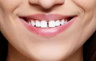 خوردن تخمه بین دندان‌ها فاصله می‌اندازد؟