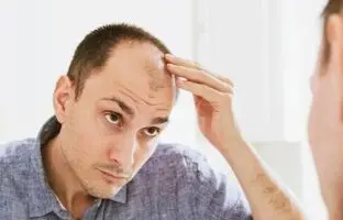 چند باور نادرست درباره ریزش مو
