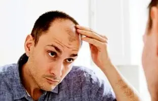 چند باور نادرست درباره ریزش مو
