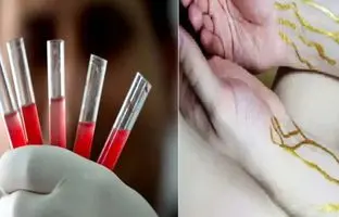 گروه خونی طلایی چیست؟ آیا شما هم گروه خونی طلایی دارید؟