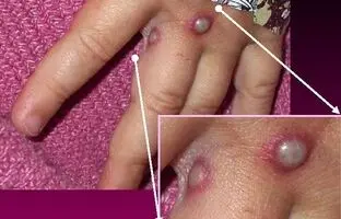سرعت بالای شیوع آبله میمونی؛ جزئیات تزریق واکسن ام‌پاکس