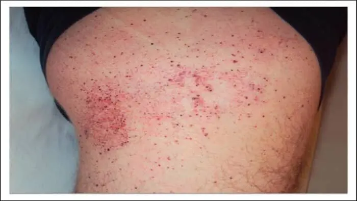 یک بیماری نادر که آقایان بیشتر به آن مبتلا می شوند