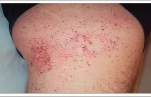 یک بیماری نادر که آقایان بیشتر به آن مبتلا می شوند
