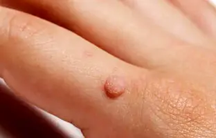 دلایلی که باعث ایجاد زیگیل می‌شود + ویدئو