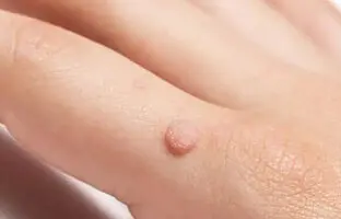 دلایلی که باعث ایجاد زیگیل می‌شود + ویدئو