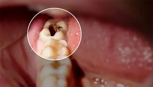 چه زمانی باید دندان عقل را کشید؟