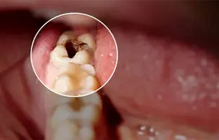 چه زمانی باید دندان عقل را کشید؟