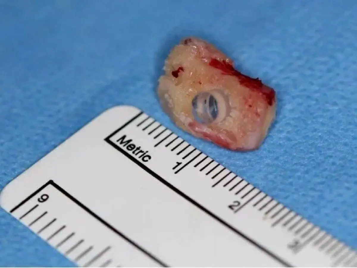 بازگرداندن بینایی با کاشت دندان + تصویر