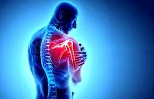 سندروم گیرافتادگی شانه چیست؟
