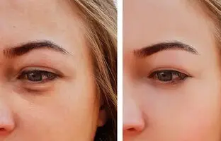 ۸ ترفند ساده و فوری برای از بین بردن پف چشم بعد از گریه