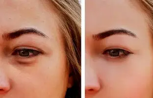 ۸ ترفند ساده و فوری برای از بین بردن پف چشم بعد از گریه