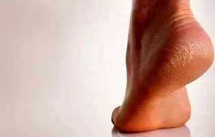  بهترین روش های سنتی برای درمان ترک پاشنه پا