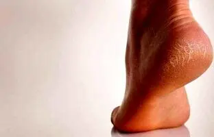  بهترین روش های سنتی برای درمان ترک پاشنه پا