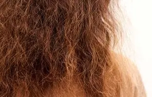 موثرترین روش درمان وزی مو