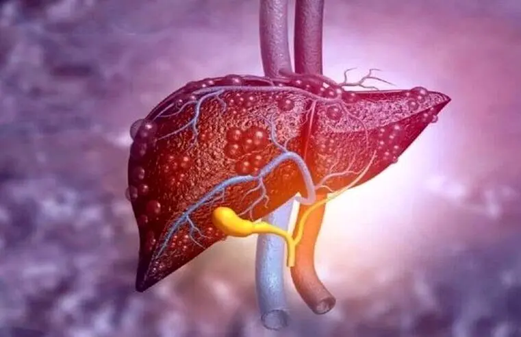 از کجا بفهمیم کبد چرب داریم؟ + ویدئو