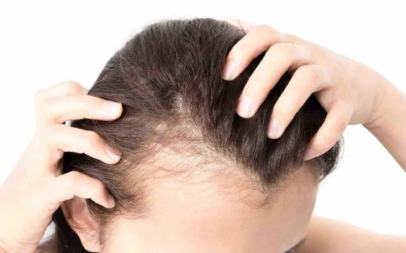 ریزش مو هورمونی چیست/  نحوه جلوگیری و درمان