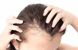 ریزش مو هورمونی چیست/  نحوه جلوگیری و درمان