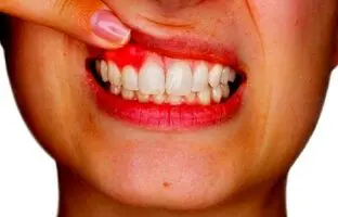 دلایل خونریزی لثه چیست؟ برای درمان آن چه کنیم؟
