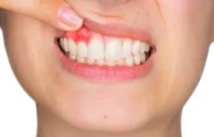 دلایل خونریزی لثه چیست؟ برای درمان آن چه کنیم؟