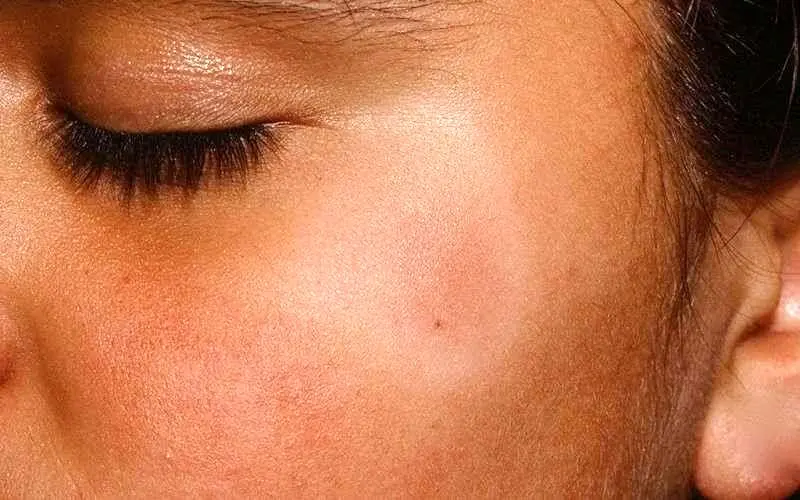 علت لکه‌های سفید روی پوست کودکان و روش‌های درمان آن