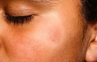 علت لکه‌های سفید روی پوست کودکان و روش‌های درمان آن