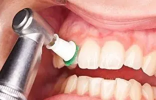 علت جرم سفید روی دندان ؛ جرم‌گیری به دندان آسیب می‌زند ؟