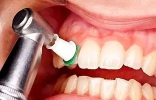 علت جرم سفید روی دندان ؛ جرم‌گیری به دندان آسیب می‌زند ؟