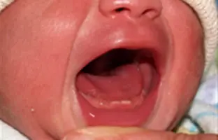  چرا برخی نوزادان با دندان به دنیا می‌آیند؟