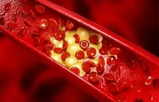  چطور آزمایش چربی خون‌مان را تفسیر کنیم؟ + ویدئو