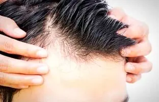 لیست داروهایی که سبب ریزش مو می شوند