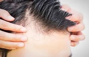 لیست داروهایی که سبب ریزش مو می شوند