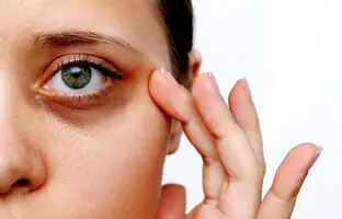 سیاهی دور چشم نشانه چه بیماری است؟ | + روش‌های درمان سیاهی دور چشم