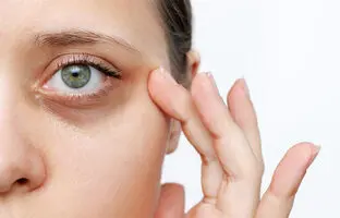 سیاهی دور چشم نشانه چه بیماری است؟ | + روش‌های درمان سیاهی دور چشم