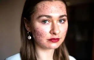 ۱۶ کار رایجی که در واقع باعث آسیب شدید به پوست صورت می‌شوند
