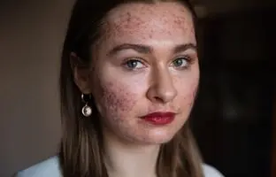 ۱۶ کار رایجی که در واقع باعث آسیب شدید به پوست صورت می‌شوند
