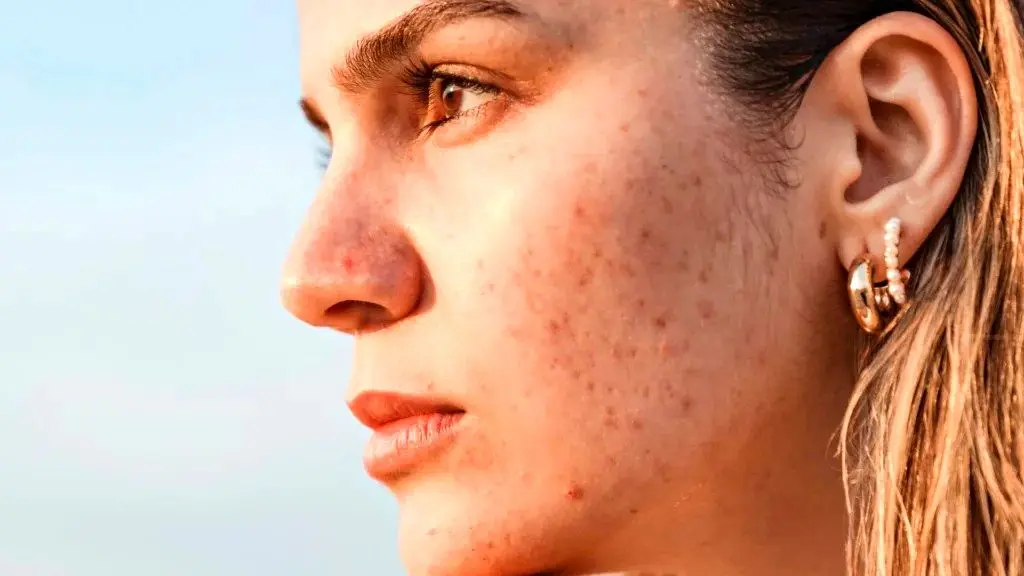 عوامل موثر بر بروز لک ناشی از ضدآفتاب و نکات مهم برای پیشگیری از آن