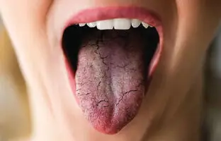  پژوهشگران چینی مکانیسم خشکی دهان را کشف کردند