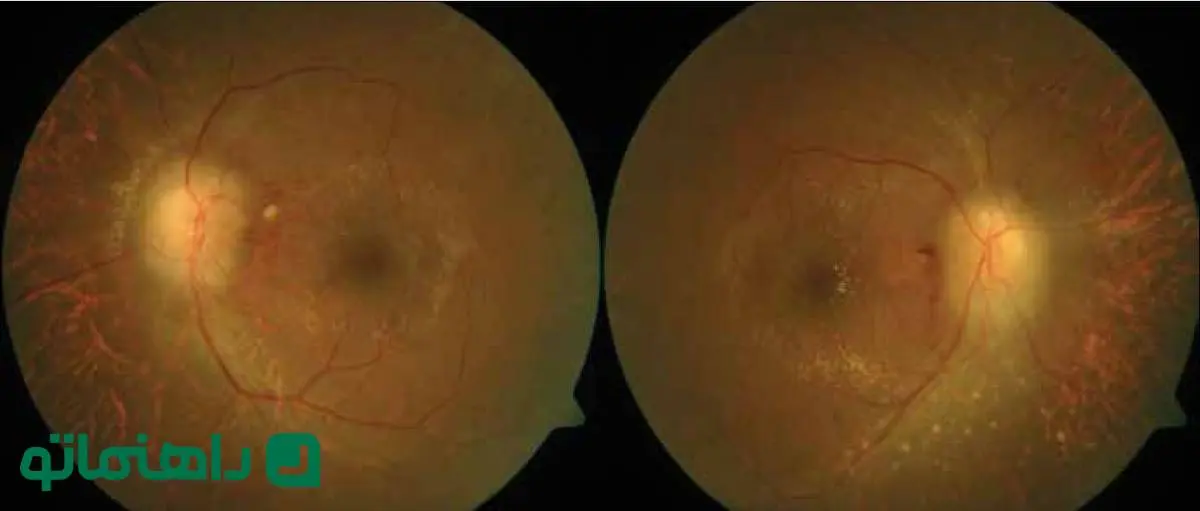 سندروم سینور لاکن چیست؟