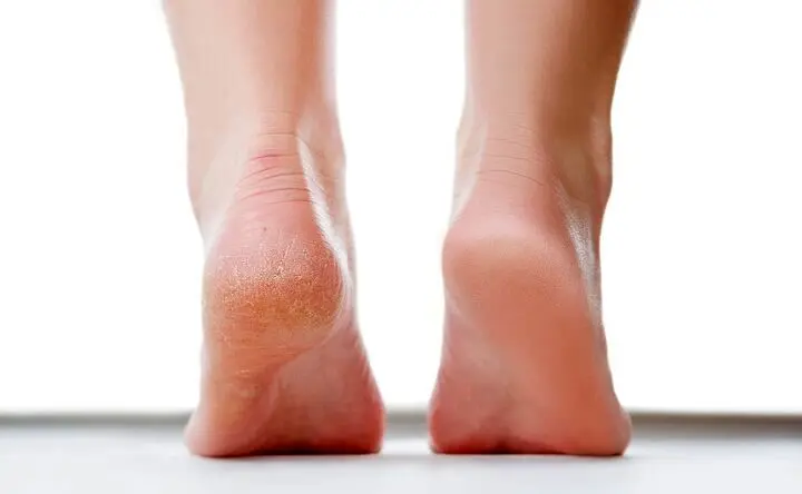 ویتامینی که کمبودش باعث ترک خوردن پاها می‌شود 