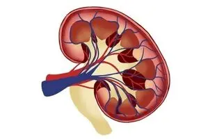 چگونه از سنگ کلیه پیشگیری کنیم؟