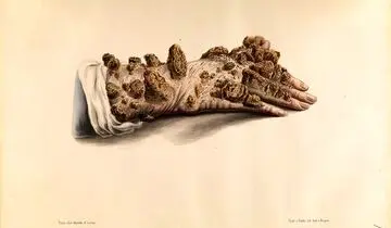 عفونتی به قدمت تاریخ؛ مبدأ جذام کجا بود؟