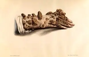 عفونتی به قدمت تاریخ؛ مبدأ جذام کجا بود؟