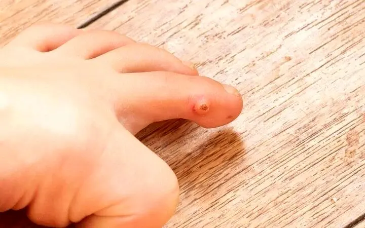 میخچه چگونه درمان می‌شود؟