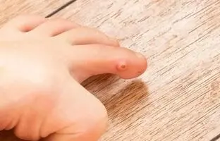 میخچه چگونه درمان می‌شود؟