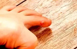 میخچه چگونه درمان می‌شود؟