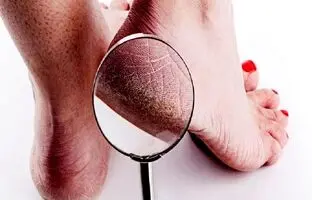 کمبود کدام ویتامین‌ها سبب ترک پاشنه پا می‌شود؟