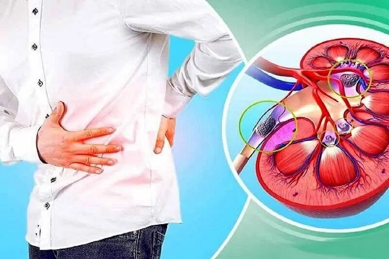 جلوگیری از تشکیل مجدد سنگ کلیه در فصل تابستان